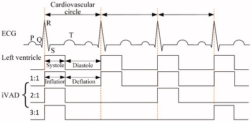 Figure 2. The pulsatile rhythm between the left ventricle and iVAD.