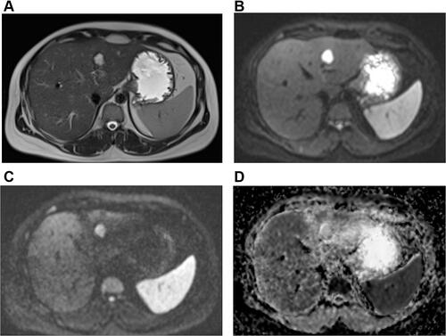 Figure 2 MRI is demonstrating segment II typical liver hemangioma in a 43-years non-prepared patient. (A) The hemangioma is homogenously hyperintense on T2WI. (B and C) The lesion is demonstrating variable high signal intensity on DWI at b values 50 and 800 mm2/s, respectively. (D) On the ADC map, the lesion’s ADC value is (2.397±0.48 ×10−3 mm2/s).