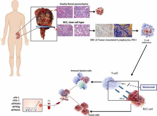 Figure 1. The assessment of PD-L1 expression using immunohistochemistry (IHC) staining in formalin-fixed paraffin-embedded (FFPE) tissue samples shows several limitations inherent to the tissue sampling, IHC detection methods and used antibodies. Circulating ICs could represent more dynamic biomarkers and be useful to predict the effect of the anti-PD-1 monoclonal antibody against RCC