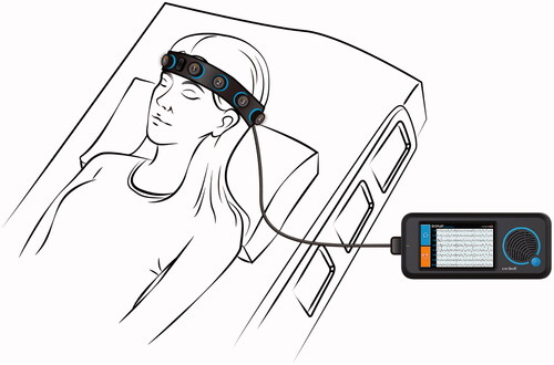 Figure 1. Rapid Response EEG System. Rapid-EEG is a new EEG device developed by Ceribell, Inc. (Mountain View, CA) and cleared by US Food and Drug Administration (FDA) since 2018. It consists of a headband with 10 electrodes (5 left and 5 right), which enables eight-channel EEG acquisition with a pocket-size battery-operated EEG recording device. The EEG can be set up by anyone without needing specialized EEG techs. The acquired data is accessible at the bedside as well as on a cloud portal that can be accessed remotely in real time.