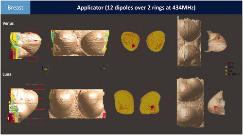 Figure 3. The benchmark breast applicator consists of 12 half-wavelength dipole antennas distributed over two rings. The benchmark patient models Venus and Luna include a superficial and a deep-seated tumor, respectively.