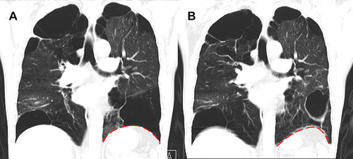 Figure 4 Coronal CT scan images at baseline and 3 months after the bronchoscopic silicone plug placement in Case 2. (A) Preoperative chest CT scan showed a GEB located in the left lower lobe. (B) Three months after the procedure, repeated CT demonstrated regression of the GEB with the upshift of the diaphragm without the collapse of the GEB. The red dotted line represents the shape of diaphragm.