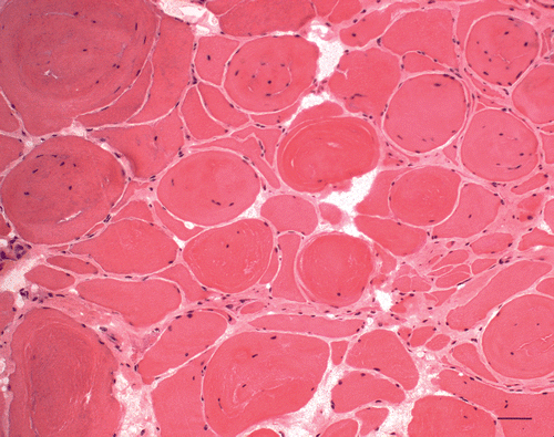 Figure 3. H&E. Variation of myofibre size, splitting of the hypertrophic fibres (up to 200 µm) with numerous inner nuclei and endomysial fibrosis (Bar 50 µm, 2nd biopsy).