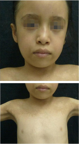 Fig. 3 Clinical appearance following treatment. Notorious improvement of dermatosis after 3 months of oral intake of 20 mg per day of nicotinamide.