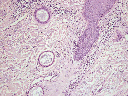 Figure 1 Reactive syringomatous proliferation in conjunction with scarring alopecia due to lichen planopilaris (patient #1), H&E, ×200
