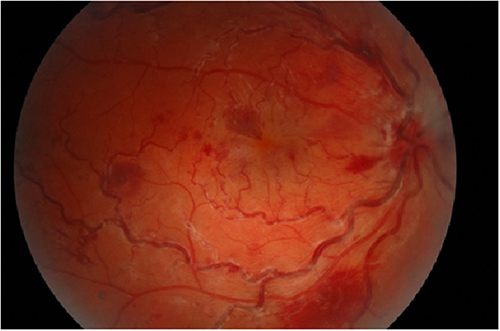 Figure 3 Central retinal vein occlusion in a 26-year-old female patient with Covid-19 infection and no other risk factors (Picture from the collection of the Ophthalmology Department, Medical University of Bialystok).