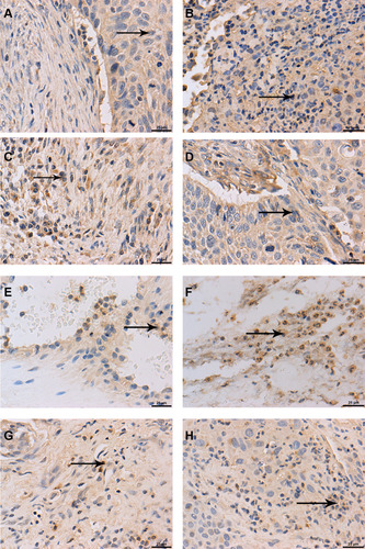 Figure 1 PD‑L1 and Glut-1 expression, and CD4+, CD8+ T cells infiltration (the black arrows point) in HNSCC at baseline (pre-RT) and after RT (magnification ×400). Positive expression of PD-L1 pre-RT (A) and after RT (B); Positive expression of Glut-1 pre-RT (C) and after RT (D); CD4+ T cells infiltration in tumor tissues pre-RT (E) and after RT (F); CD8+ T cells infiltration in tumor tissues pre-RT (G) and after RT (H).