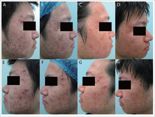 Figure 3. Clinical images of one patient. Acne lesions on the right side was treated by red light-PDT and acne lesions on the left side were treated by IPL-PDT.(A)(E) at baseline.(B)(F)before 3rd treatment.(C)(G) at 4 weeks after 3rd treatment.(D)(H)at 8 weeks after 3rd treatment.