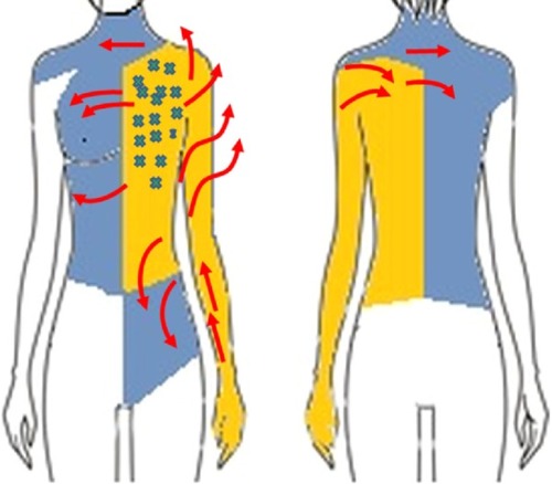 Figure 16 Directions of manual lymph drainage after axillary lymphadenectomy (substitute lymphatic flow areas are depicted in blue and regions of edema and so-called gravity points are in yellow).