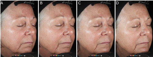 Figure 4 (A–D) Improvement in perioral coarse lines and hyperpigmentation in a 65-year-old female who received the DG plus HA5 serums combined treatment. Digital photographs were taken with parallel polarized light at the following timepoints: before treatment (A), immediately after the DG procedure (B), 3 days post-DG (C), and at week 12 (D).
