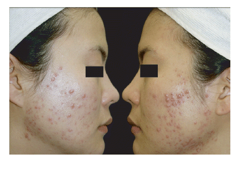 Figure 1. Both cheeks with multiple inflammatory papules and acne scarring before treatment.