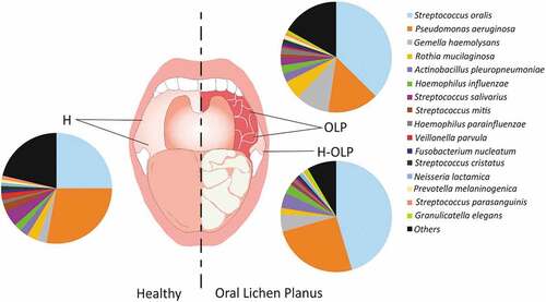 Figure 1. Microbiota associated with the buccal mucosa in healthy individuals and patients with Oral Lichen Planus (OLP). Sampling points are represented with lines, and the proportions of the bacterial species corresponding to each sample type are plotted in pie charts. Bacteria below 1% proportion were included in the ‘others’ category. H, healthy controls; OLP, affected sites; H-OLP; unaffected sites.