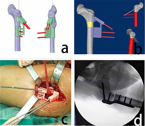 Figure 1. Design and use of the 3D printed navigation template (a) the 3D navigation template model and the kirschner wire channel were reverse designed according to the 3D reconstruction of the femur. (b) A navigation template was used to simulate the osteotomy process using the kirschner wire as a lever. (c) the navigation template was accurately positioned at the femoral osteotomy during surgery. (d) the intraoperative examination was performed using C-arm x-rays [Citation19]