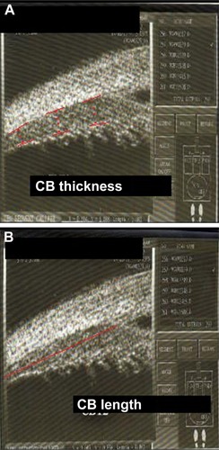 Figure 1 (A) Width measurements with caliper positioned perpendicular to the ciliary muscle–sclera and (B) visible ciliary muscle length from the scleral spur to the posterior tip of the ciliary muscle (red line).