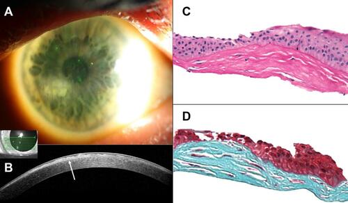 Figure 4 Slit-lamp photographs, anterior segment optical coherence tomography (OCT), and histological images of a 60-year-old white female with a long-standing history of a corneal opacity that was difficult to further subtype by clinical examination alone. (A) Slit-lamp photograph of the right eye demonstrating a whitish-gray, paracentral corneal opacity at eight-o’clock. (B) Heidelberg Spectralis high-resolution OCT image of the right eye depicts a hyper-reflective subepithelial lesion (arrow) with irregularly thinned overlying epithelium. Centrally, Bowman’s layer is intact but is absent peripherally. The classic appearance of the lesion led to a final diagnosis of Salzmann nodular degeneration. (C) Subepithelial fibrocellular tissue with irregular collagen lamellae is present. The overlying epithelium is of variable thickness (Periodic acid Schiff original magnification x400). (D) The subepithelial fibrocellular tissue stains positively for collagen (Gomori’s one step trichrome original magnification x400).