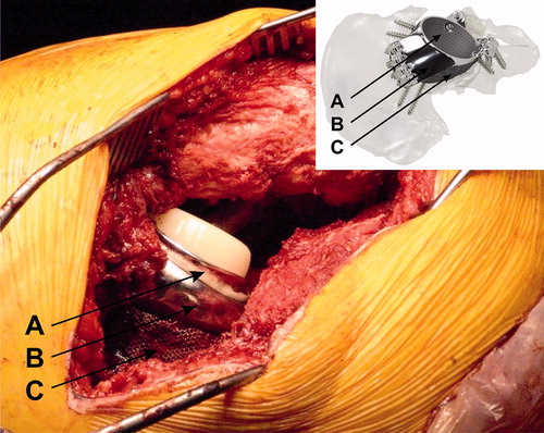 Figure 2. Dual mobility cup cemented into the custom-made implant. A = (place of) dual mobility cup. B = triflange cage. C = porous metal augment.