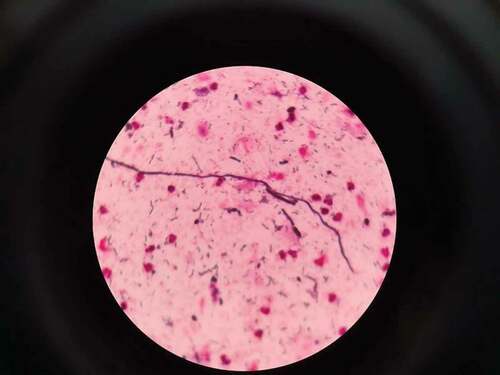Figure 1. Gram stain shows budding yeast like cells with pseudo hyphae along with few epithelial cells, no pus cells, numerous Gram-negative rods and Gram-positive cocci in pairs