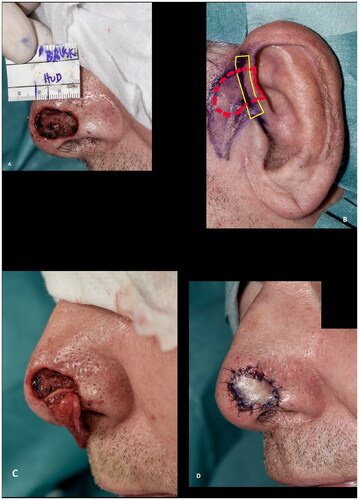 Figure 1. Surgical technique. (A) Recipient site after radical resection of basal cell carcinoma. (B) Preoperative marking at the donor site. Note the marking of the harvested cartilage (solid line) which were approximately 3–5 mm in height and 3–5 mm in length and the skin (dashed line). (C) Cartilage wings in place, secured in subcutaneous pockets parallel to the alar rim with dissolvable sutures. (D) Composite graft in place.