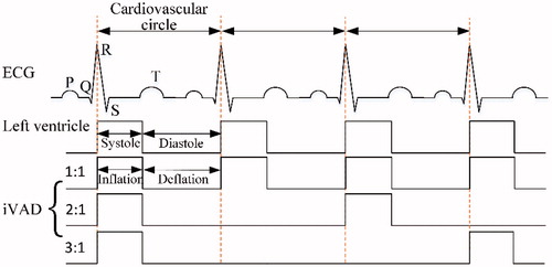 Figure 2. Illustration of the pulsatile rhythm of the left ventricle and the iVAD.