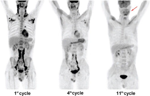 Figure 1. Treatment response of lenalidomide-based regimen documented on PET scans.