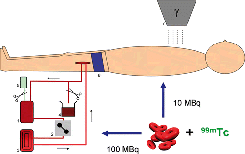 Figure 1. Principle of hyperthermic isolated limb perfusion. (1) reservoir; (2) pump; (3) oxygenator and heater; (4) Discharge; (5) Ringer's lactate; (6) tourniquet; (7) scintillation probe.
