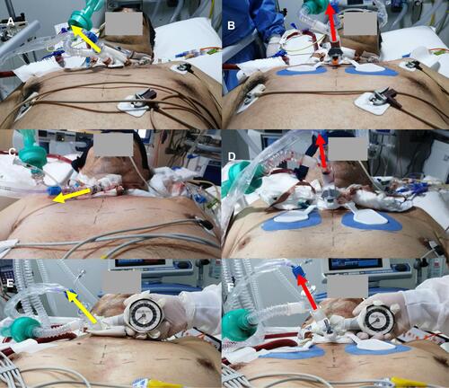 Figure 6 Comparisons Between Sequential Photographs Taken Prior To And After The Placement Of The DYNAtraq Device In Ventilated Patients. Sequential pictures from three selected patients to show cephalo-caudal view of intrasubject comparisons prior to and after the placement of the DYNAtraq device. Pictures (A, C and E) represent the referent caudal-cephalic photographs patients without the device, whereas pictures (B, D and F) show caudal-cephalic photographs of the same patient once the device has been placed on the chest taking the midline of the sternum for reference. Color code: (Yellow arrows): axis of the tracheostomy tube alignment at baseline (without the device) position; (Red arrows): axis of the tracheostomy tubes using the DYNAtraq device. It is also shown in (E and F) pictures the degree of lateral misalignment in a patient in the face of equivalent left to right push loading on the tracheostomy tube. Note that the device offers greater tolerance to the pushing load as it is deduced from a lower angular displacement despite of an equivalent external load.