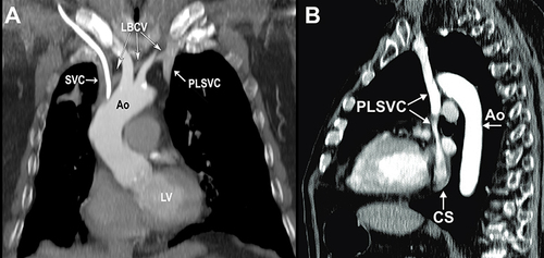 Figure 4 Contrast-enhanced computed tomography of the thorax. (A) Coronal view shows the proximal part of the PLSVC with a minor LBCV connecting to the SVC (note the central vein catheter within the SVC): (B) Sagittal view shows the inflow of the PLSVC into the coronary sinus.