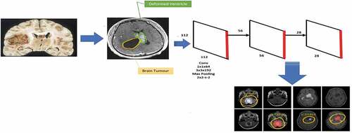 Figure 5. The proposed i-YOLOV5 model for Brain Tumor Detection.