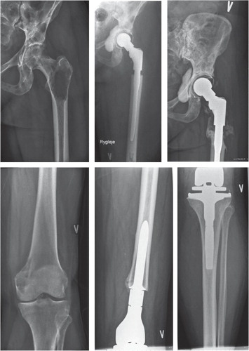Figure 1. Upper panels. A patient suffering from breast cancer and left hip pain because of multiple osteolytic metastases of the left hip and acetabular region (left panel); postoperatively, after resection of the proximal femur and insertion of a total hip replacement using an MP reconstruction hip stem (middle panel) and status 4 years later (right panel).Lower panels. A patient with previous cancer of the bladder, suffering from knee pain because of a solitary metastasis of the medial femoral condyle (left panel); status 4 months postoperatively after resection of the distal femur and reconstruction with a GMRS prosthesis (middle and right panels).