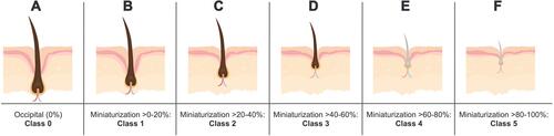 Figure 2 A proposed classification system to quantify relative HFM within the same subject. (A) Class 0 represents full-thickness hairs unaffected by AGA. (B–F) Classes 1–5 represent AGA-affected hairs benchmarked to Class 0, with miniaturization segmented by 20% increments per class.