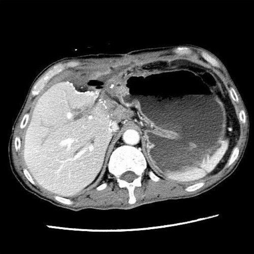 Figure 1. Computed tomography image of the upper abdomen. A small fluid collection with gas pocket was found and rim enhancement was observed around the tubal drains.