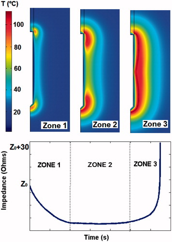 Figure 6. Two-dimensional tissue temperature distribution during RFA and impedance evolution. The impedance progress can be divided into three intervals: 1) initial impedance drop; 2) impedance plateau; and 3) abrupt increase of impedance. These zones are related to the physical conditions of the tissue during the RFA process [Citation30].