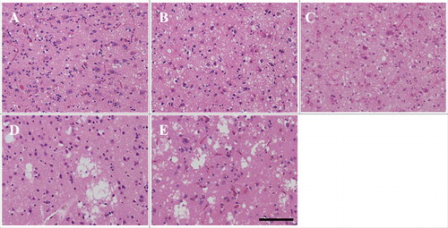 Figure 4. Microscopic findings of frontal lobe HE staining in patients 7–11 (A: patient 7, B: patient 8, C: patient 9, D: patient 10, E: patient 11). Fine vacuoles are observed in MM1-type sporadic Creutzfeldt–Jakob disease (sCJD) (A–C). Large confluent vacuoles are observed in MM2C-type sCJD (D, E). Scale bars: 100 μm HE, hematoxylin and eosin.