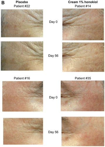 Figure 3B Antiwrinkle effect of a preparation containing 1% of honokiol, on the crow’s feet of two volunteers.