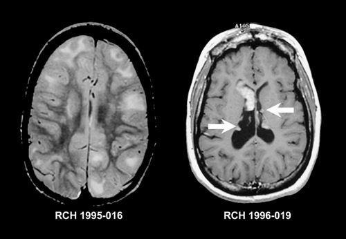 Figure 1. Imaging features of tuberous sclerosis. Axial T2 -weighted MRI (left) and contrast-enhanced axial T1 -weighted MRI (right). The image on the left shows multiple focal areas of broadened gyri, blurring of the gray-white junction and increased signal in the subcortical white matter typical of cortical tubers. The image on the right shows multiple subependymal nodules (arrows) consistent with subependymal hamartoma and a large enhancing lesion at the right foramen of Monro consistent with a giant cell astrocytoma. MRI, magnetic resonance imaging