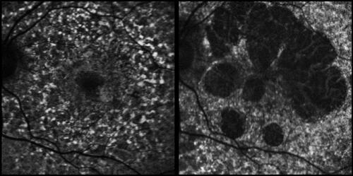 Figure 3 (Patient 8) Fundus autofluorescence at presentation and 4 years later, depicting the increase in areas of RPE atrophy.