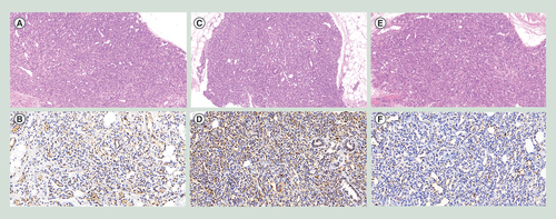 Figure 1. Pathological sections of tumors of infantile hemangiomas (n×zoom level of CaseViewer 2.0). (A) HE stain of sample 1, 10.0×. (B) Immunohistochemistry of GLUT-1 of sample 1, 20.0×. (C) HE stain of sample 2, 10.0×. (D) Immunohistochemistry of GLUT-1 of sample 2, 20.0×. (E) HE stain of sample 3, 10.0×. (F) Immunohistochemistry of GLUT-1 of sample 3, 20.0×.HE: Hematoxylin and eosin.