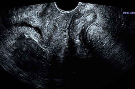 Figure 6 Normal vaginal ultrasound image indicating the disappearance of the mass (2020.07.03).