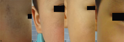 Figure 1 Treatment process for type I and II nevus of Ota in infants. (A) Before treatment; (B) 6 months after the first treatment; (C) 6 months after the third treatment; (D) 2 years after the 4th treatment.