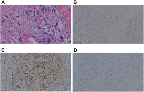 Figure 3 Pathological findings of rectal carcinoma skin metastases.