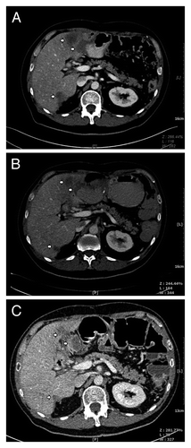 Figure 1. CT scans of the patient before and after panitumumab-vemurafenib treatment for metastatic CRC. Tumor masses (arrow) can be seen in the liver of the patient before initiation of panitumumab-vemurafenib treatment (A). The masses (arrow) became hypodense, homogenous and significantly reduced in size on CT obtained 3 and 6 mo after treatment (B and C), indicating good response to combination treatment.
