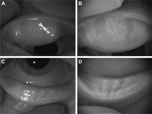 Figure 1 Representative images of an eye with a history of chalazion.