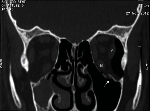 Figure 3 Coronal orbital computed tomography scan shows a left linear, nondisplaced fracture of the orbital floor (white arrow) without muscle entrapment or fat herniation.