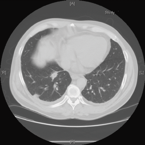 Fig. 3.  CT scan of the chest without contrast done on day 15 after administration of phenol. Multiple nodules were present in right upper lobe, right lower lobe, left upper lobe, and left lower lobe. Small right pleural effusion and 1cm pretracheal lymph node were also present.