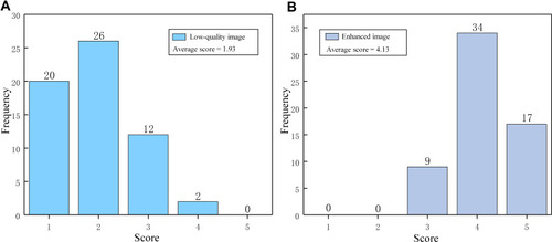 Figure 7 Score distribution of low-quality images and enhanced images (A is the score distribution of low-quality images. B is the score distribution of enhanced images. It reflects the auxiliary potential of the image quality improvement module for actual clinical researchers.).