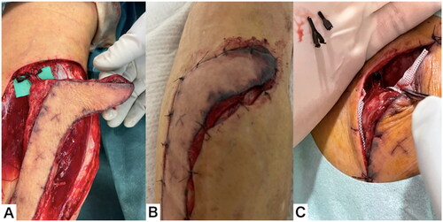 Figure 5. Clinical course throughout the 5 d after flap elevation. (A) Each of the three vessels in the proximal vascular pedicle was clamped with a separate vascular clip. (B) After 6 h, the flap was clearly congested. (C) Immediately after removing the clips, the color tone of the flap normalized.