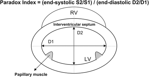 Figure 1. Diagram of the method applied to quantify the degree of septal paradoxical motion using the paradox index. D1, length of the short-axis diameter (perpendicular to the interventricular septum) from the left ventricular septal endocardium to the endocardium of the posterolateral free wall; D2, length of the orthogonal short-axis diameter between the endocardial surfaces of the anterior and inferior left ventricular free wall; LV, left ventricle; RV, right ventricle.