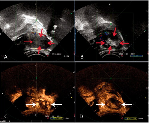Figure 2. Ultrasound images obtained during HIFU treatment for placenta accreta. (A) pre-HIFU ultrasound image showed hypoechoic area in the uterus (read arrows); (B) post-HIFU utrasound image showed grey scale changes in the treated region (read arrows); (C) pre-HIFU contrast-enhanced ultrasound image showed perfusion in the placenta accreta (white arrows); (d) post-HIFU contrast ultrasound image showed no perfusion in the placental tissue (white arrows)