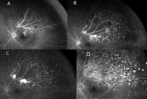 Figure 4 Retinal neovascularizations progression from under-treated retinal ischemia. The patient presented with left eye recurrent vitreous hemorrhage following the diagnosis of a supero-temporal branch retinal vein occlusion (BRVO). Ultra-widefield fluorescein angiograms (UWF-FA) were performed at 5 to 9 months interval showing the course of retinal neovascularizations (NVE) progression over the follow-up period whilst receiving laser treatments. (A) Angiographic “3Bs pattern” was observed with a small NVE developed within the ischemic macula to account for the initial mild vitreous hemorrhage. Target laser photocoagulation was requested on black retinal ischemia (black-RI). (B) Seven months post-laser treatment, multiple new NVEs were seen at different locations, developed from residual inadequately treated black-RI territory. One NVE was at the water-shed border, one was along a major vessel within the black-RI. Further laser treatment was requested. (C) Five months later, the patient presented with further vitreous hemorrhage due to progression of NVE when residual black-RI remained under-treated. (D) Total resolution of all NVEs confirmed from repeated UWF-FA 9 months after the last laser treatment, showing sufficient laser coverage of the entire black-RI area. The patient had no further vitreous hemorrhage and retained excellent vision despite the disease and treatment proximity to fovea.