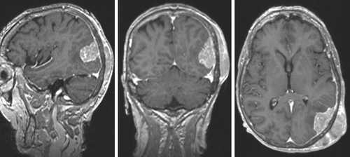 Figure 1. Magnetic resonance imaging showing a dura based solid lesion in the left occipital lobe with extracranial extension.